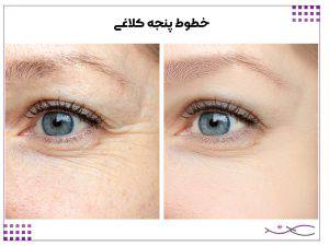 خطوط پنجه کلاغی