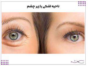 چروک ناحیه اشکی یا زیر چشم