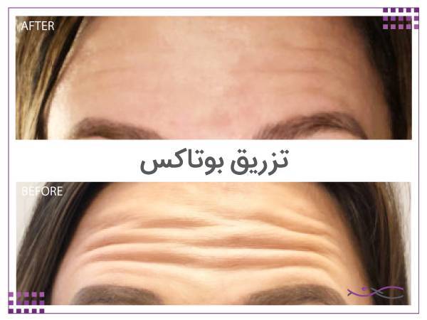 تزریق بوتاکس در میرداماد تهران 7 تزریق بوتاکس