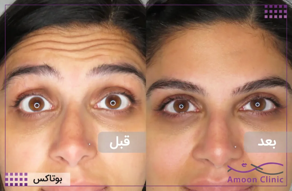 تزریق بوتاکس