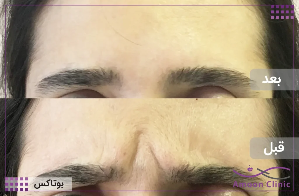 تزریق بوتاکس خط اخم
