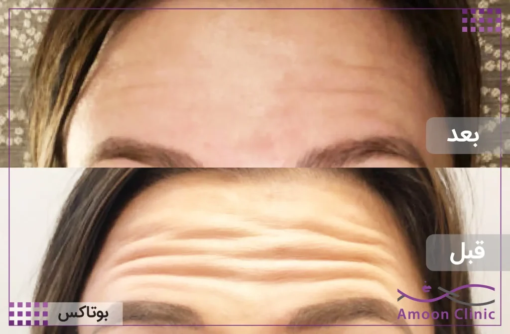 نمونه اجرایی تزریق بوتاکس
