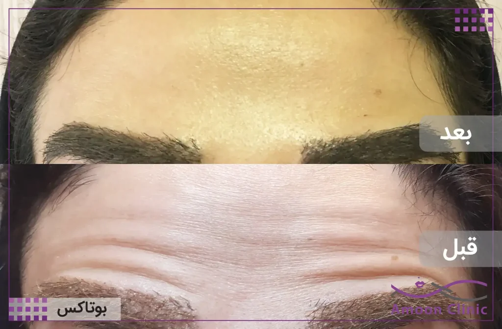 تزریق بوتاکس آمون