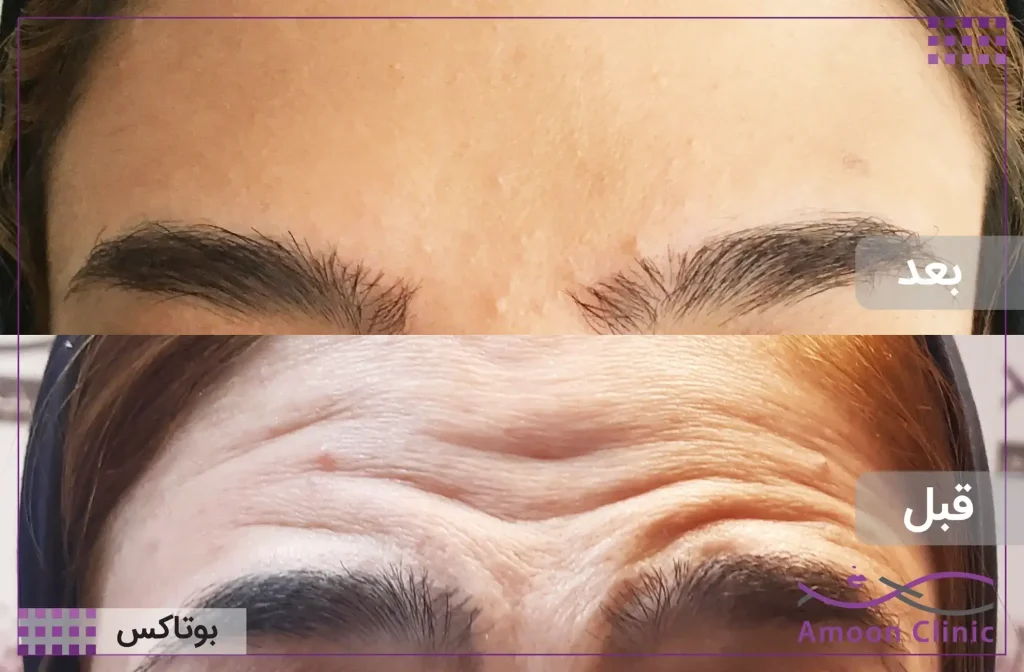 بوتاکس صورت