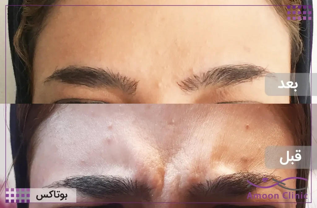 بوتاکس خط اخم