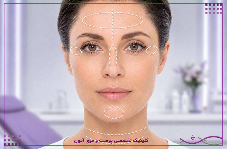 نواحی مناسب بوتاکس