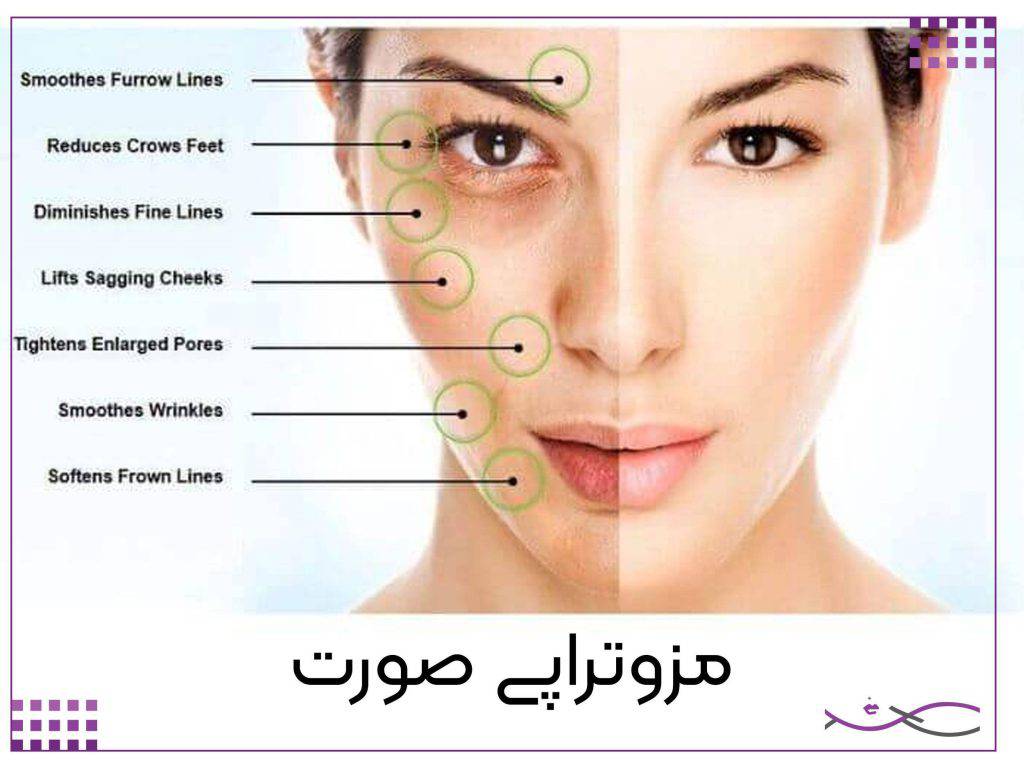 مزوتراپی صورت
