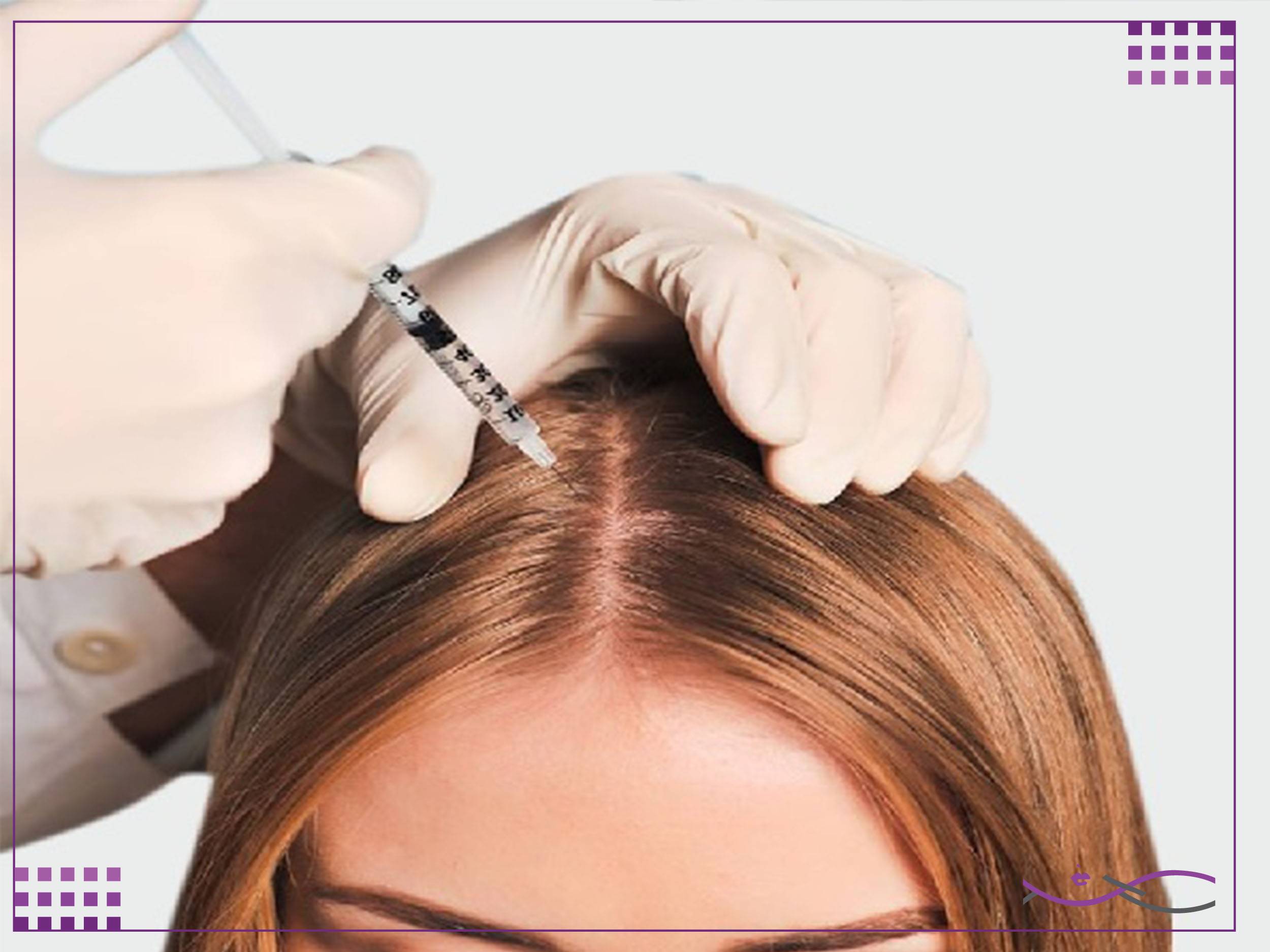 کاربردهای مزوتراپی سر