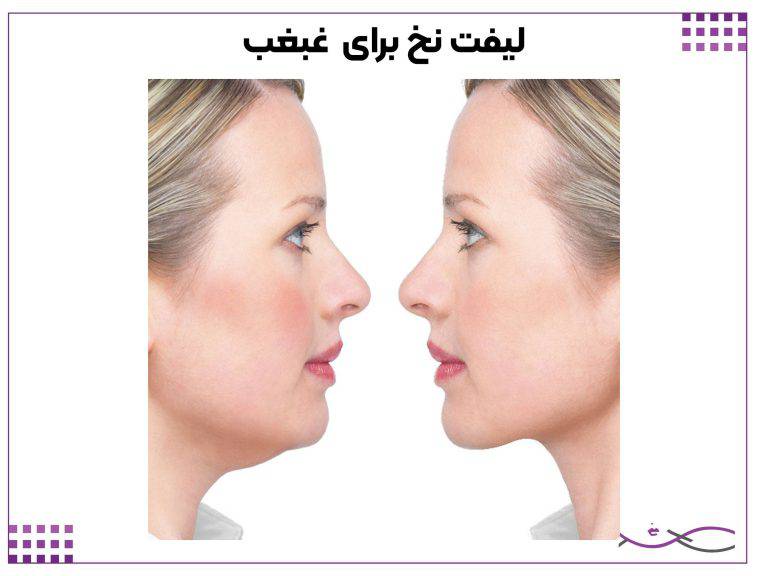 لیفت صورت با نخ؛ هزینه، ماندگاری و عوارض 3 لیفت نخ برای چانه دوتایی