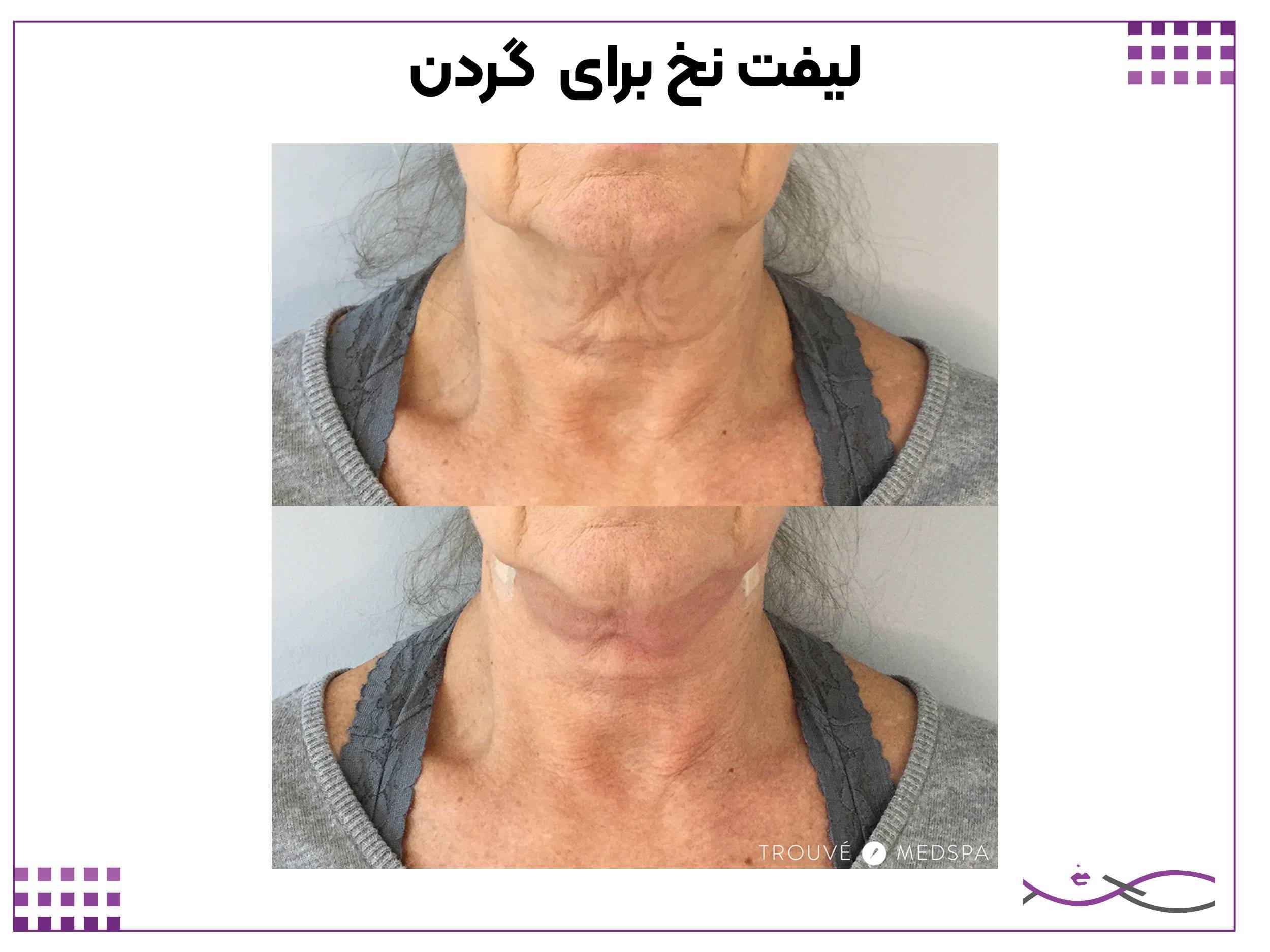لیفت نخ گردن