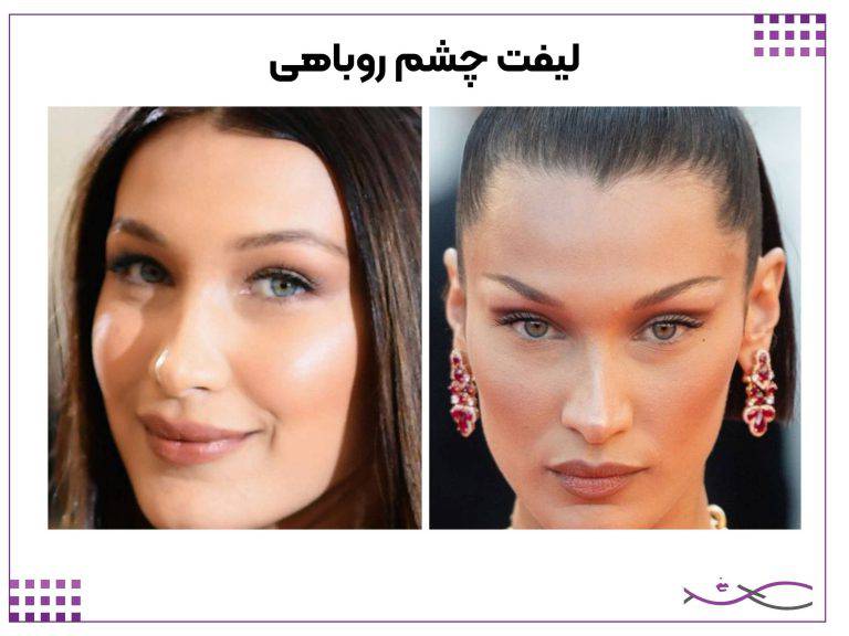 لیفت صورت با نخ؛ هزینه، ماندگاری و عوارض 2 لیفت چشم روباهی