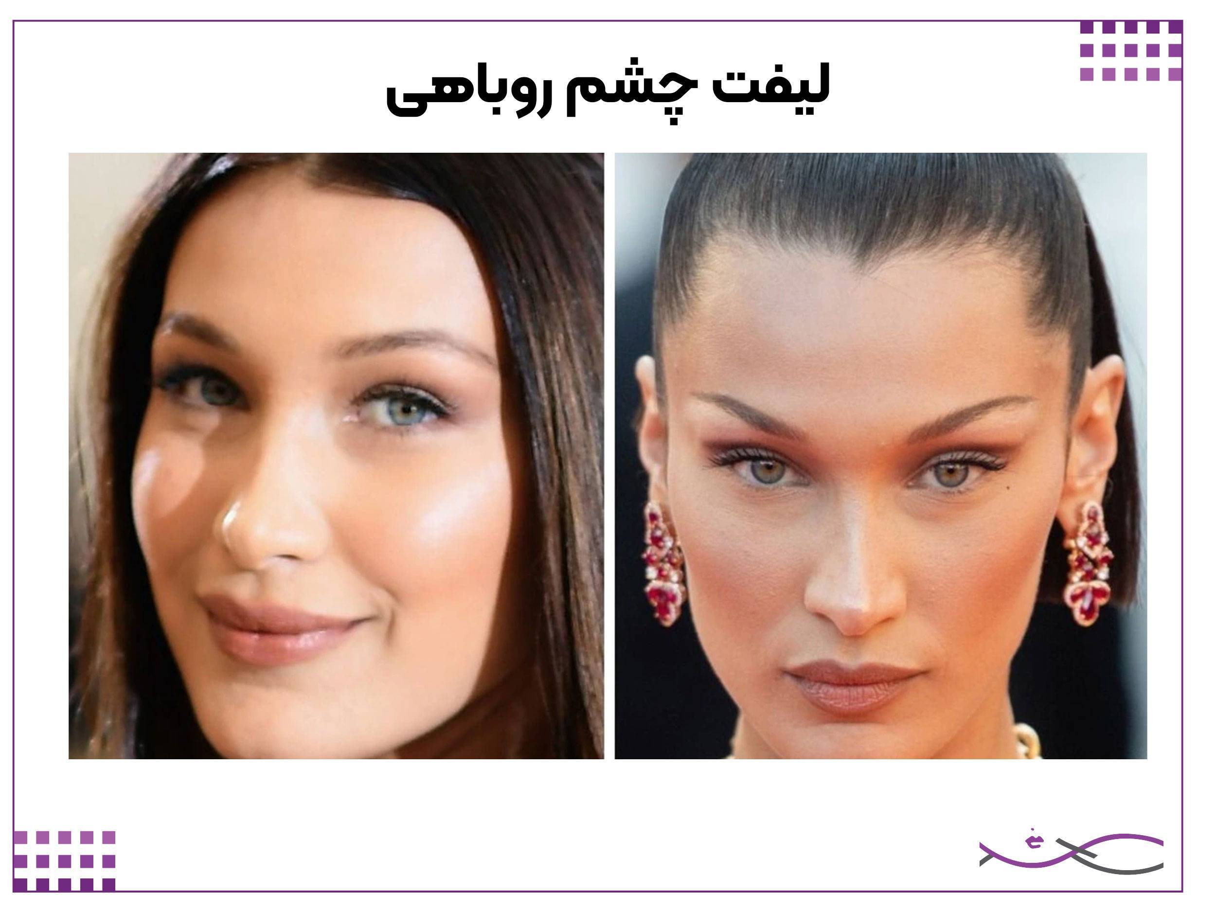 لیفت چشم روباهی بلا حدید