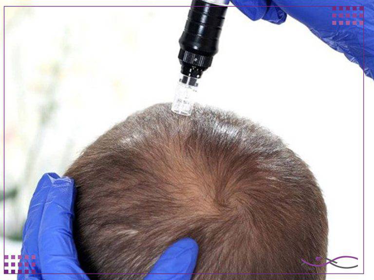 روش های جدید جوانسازی پوست 3 مزونیدلینگ مو