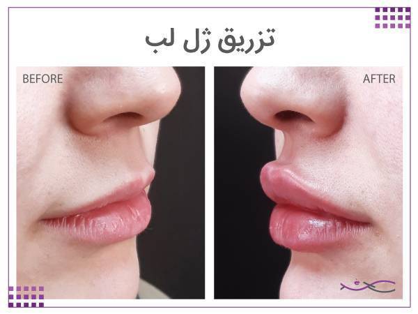 نمونه کار تزریق ژل لب کلینیک آمون