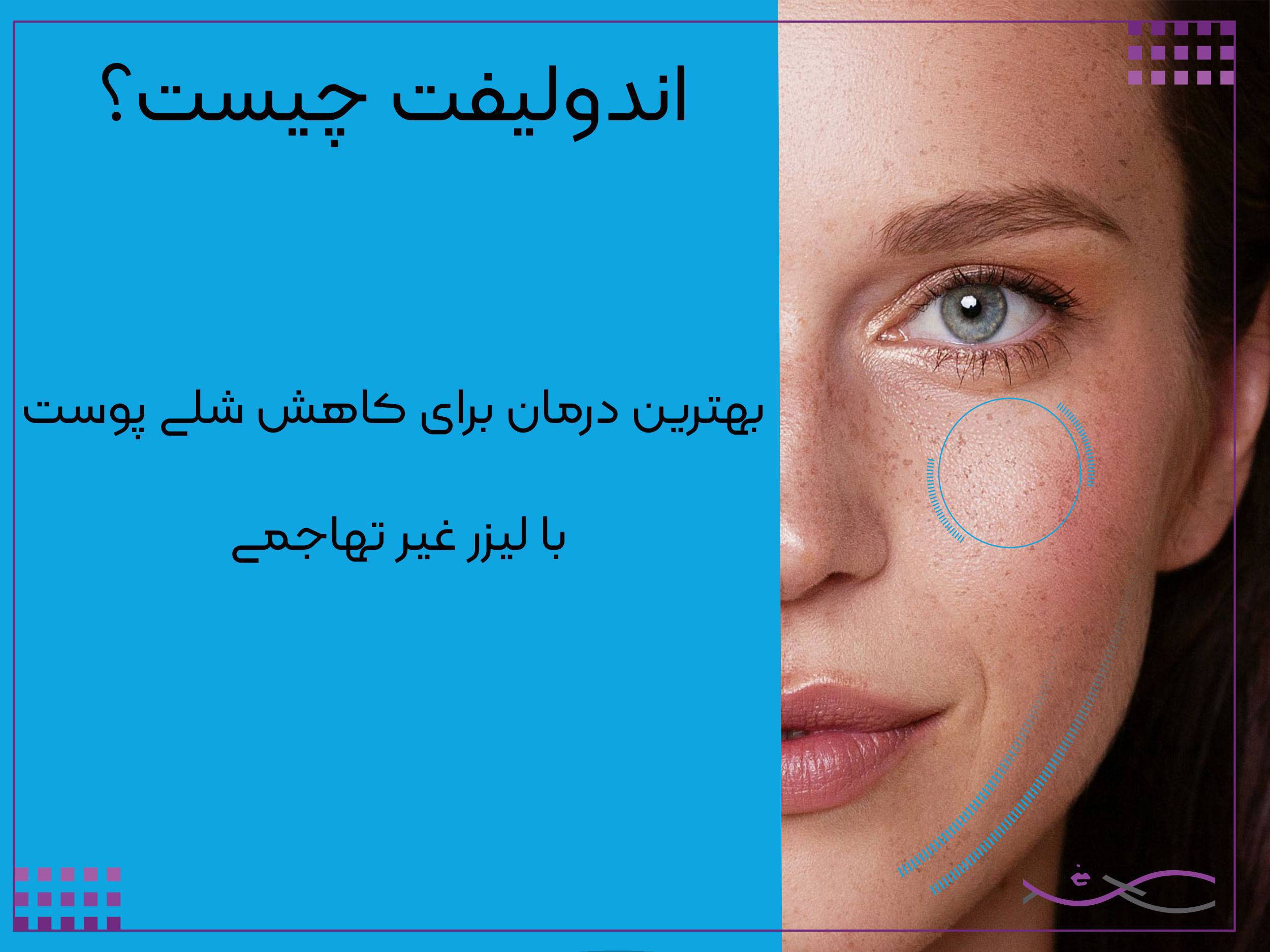 اندولیفت چیست
