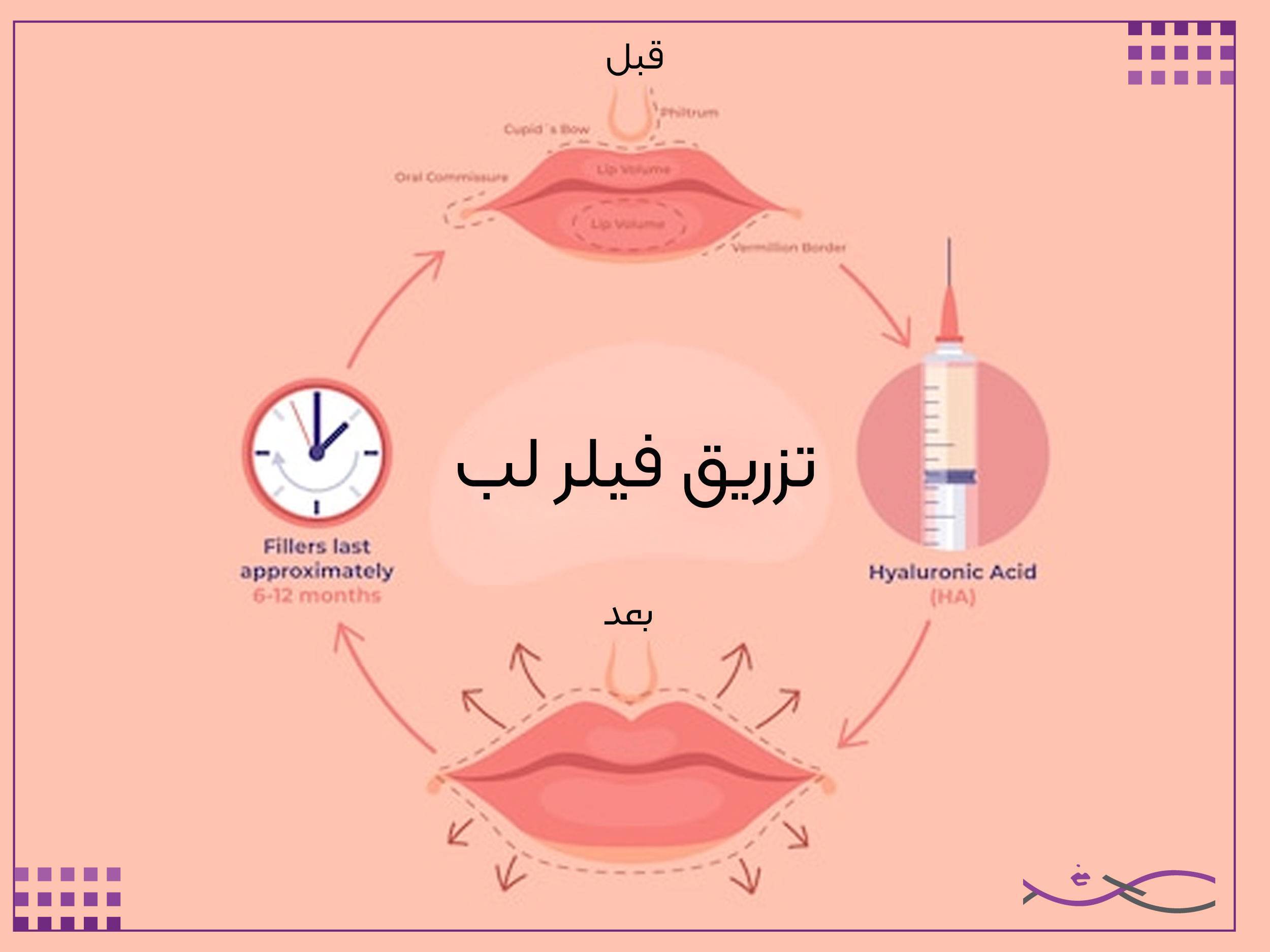 تزریق فیلر لب