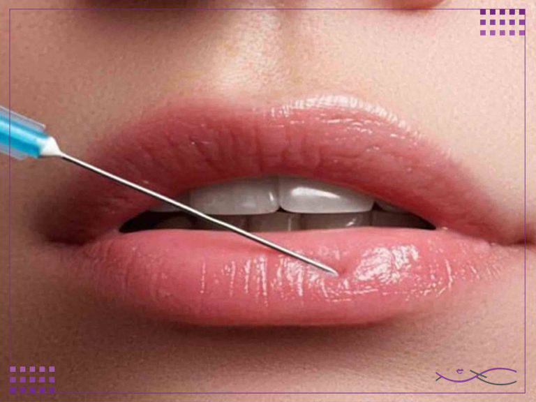 ژل لب طبیعی؛ انواع مدل، عوارض، ماندگاری و هزینه 10 هزینه تزریق ژل لب