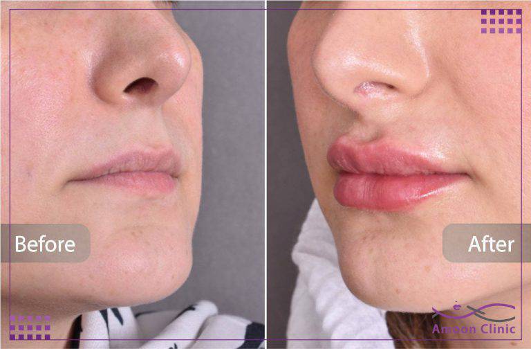 ژل لب طبیعی؛ انواع مدل، عوارض، ماندگاری و هزینه 9 ژل لب نچرال دکتر یارقلی