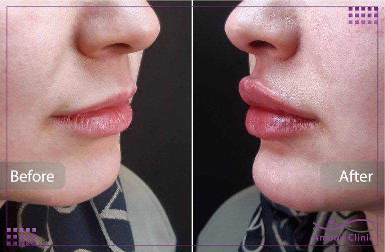 ژل لب طبیعی؛ انواع مدل، عوارض، ماندگاری و هزینه 5 تزریق ژل لب کلینیک آمون