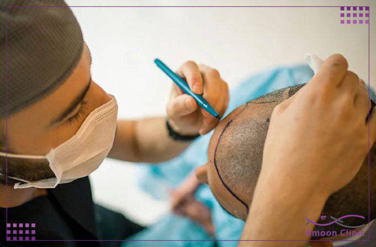 عوارض کاشت مو چیست؟ کاشت مو باعث مرگ میشود؟ 3 65 min