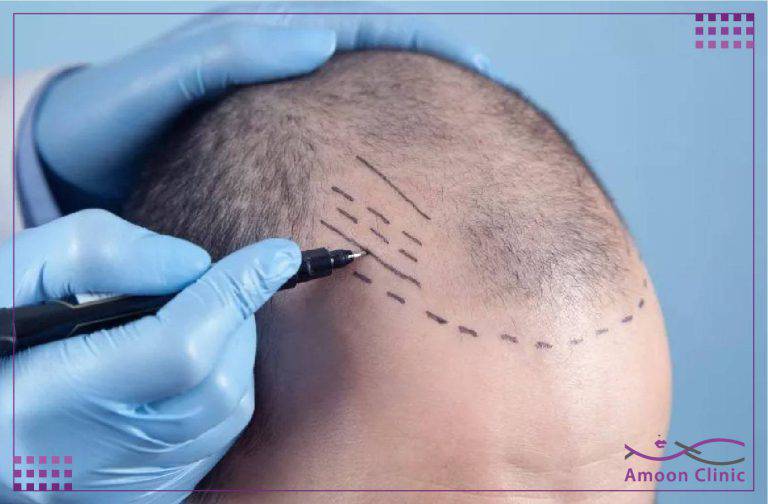 عوارض کاشت مو چیست؟ کاشت مو باعث مرگ میشود؟ 2 66 min