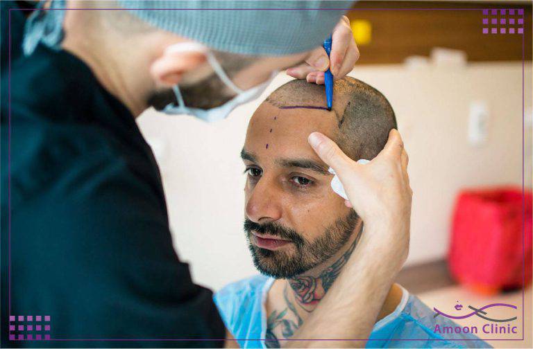 عوارض کاشت مو چیست؟ کاشت مو باعث مرگ میشود؟ 6 67 min
