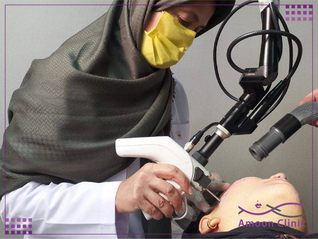یولیزر چیست