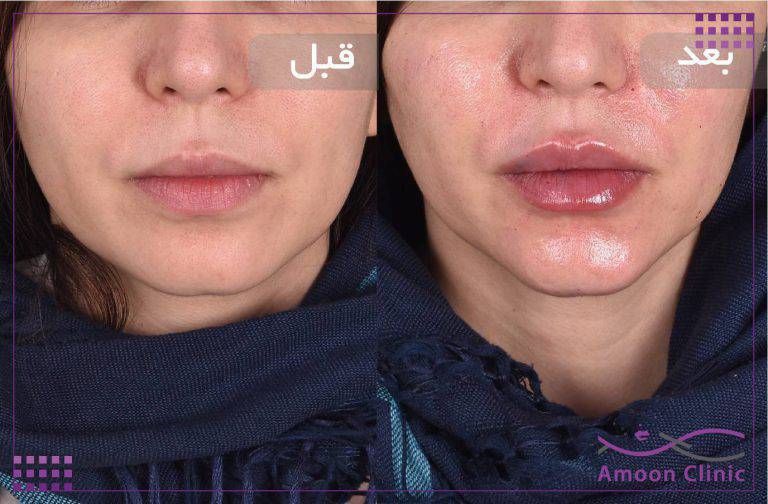 نمونه قبل و بعد زیبایی 8 قبل و بعد تزریق ژل لب با مدل نچرال