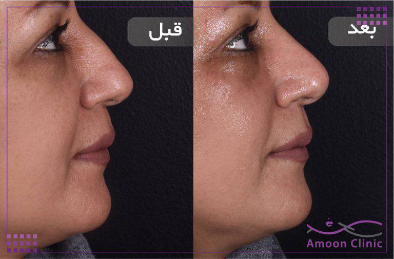 نمونه قبل و بعد زیبایی 50 قبل و بعد فرمدهی بینی بدون جراحی از نمای نیمرخ