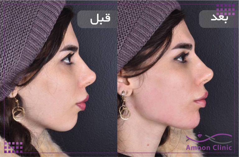 زاویه ‌سازی صورت