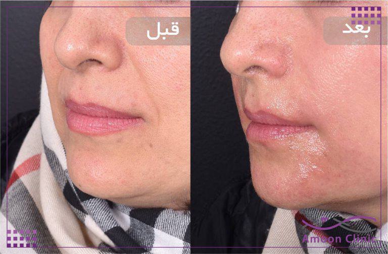 نمونه قبل و بعد زیبایی 7 قبل و بعد ژل لب از زاویه سهرخ و افزایش حجم لب