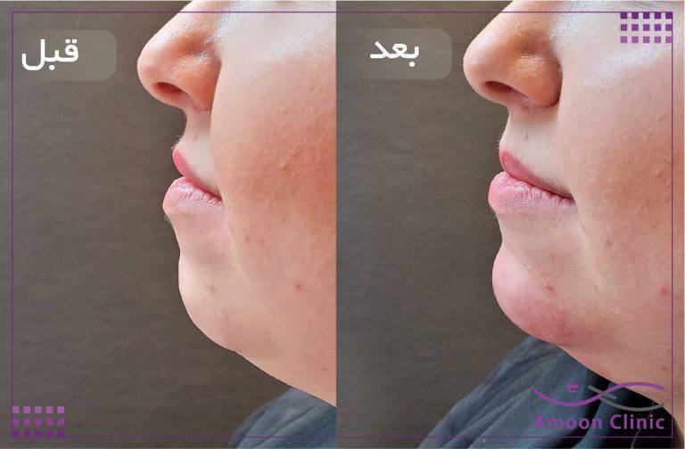 نمونه قبل و بعد زیبایی 38 قبل و بعد تزریق ژل چانه از نمای نیمرخ کامل