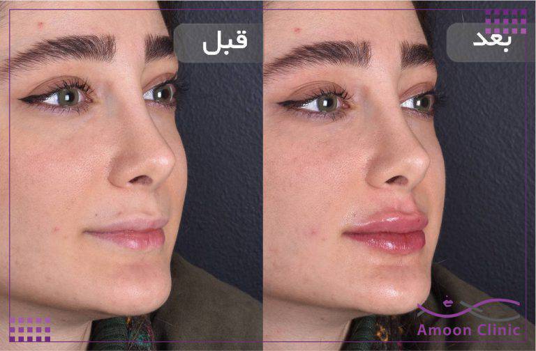 نمونه قبل و بعد زیبایی 6 نمونه قبل و بعد تزریق فیلر لب در کلینیک آمون میرداماد