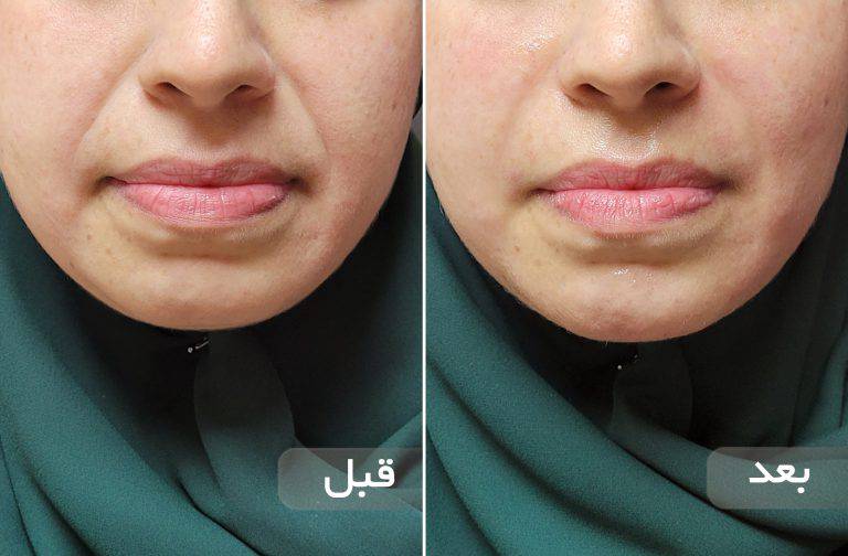 نمونه قبل و بعد زیبایی 26 قبل و بعد ژل خط خنده و کاهش چین دور دهان