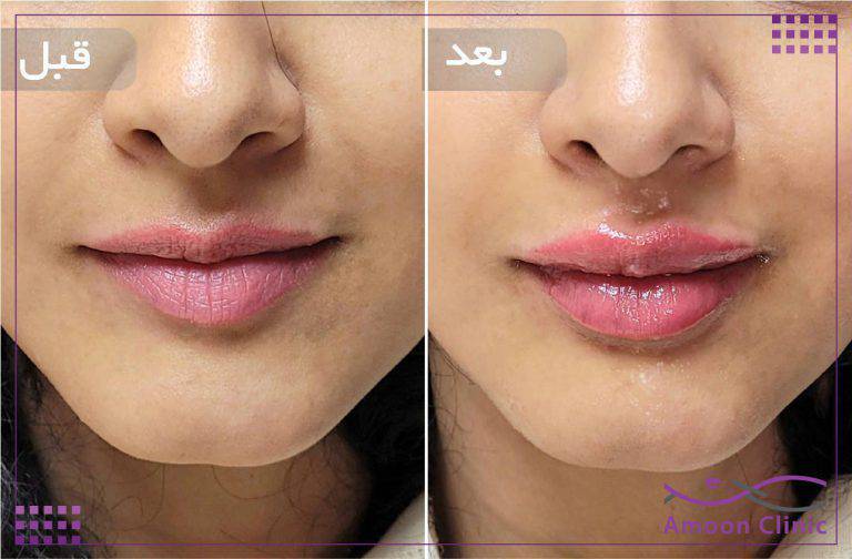 نمونه قبل و بعد زیبایی 4 قبل و بعد تزریق ژل لب و برجسته شدن قوس لب بالا