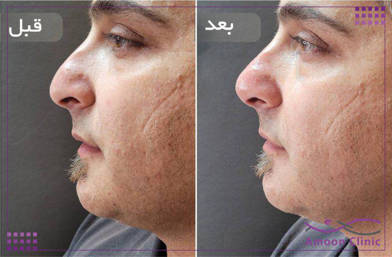 نمونه قبل و بعد زیبایی 49 قبل و بعد فرمدهی بینی و اصلاح تقارن صورت