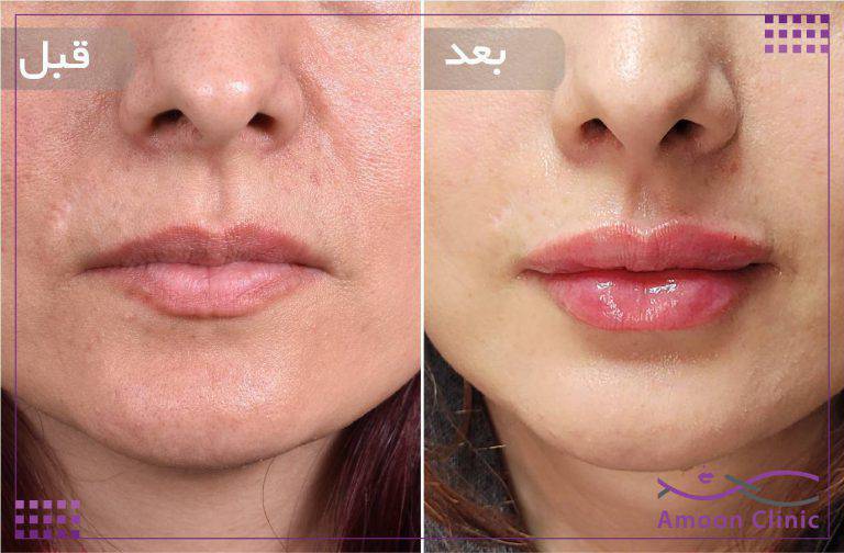 نمونه قبل و بعد زیبایی 2 قبل و بعد ژل لب با حجمدهی متعادل لب بالا و پایین