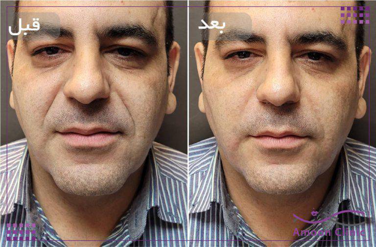 نمونه قبل و بعد زیبایی 25 قبل و بعد تزریق ژل خط خنده در آقایان