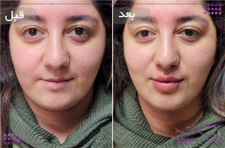 قبل و بعد تزریق ژل لب از نمای روبه‌رو صورت در کلینیک آمون