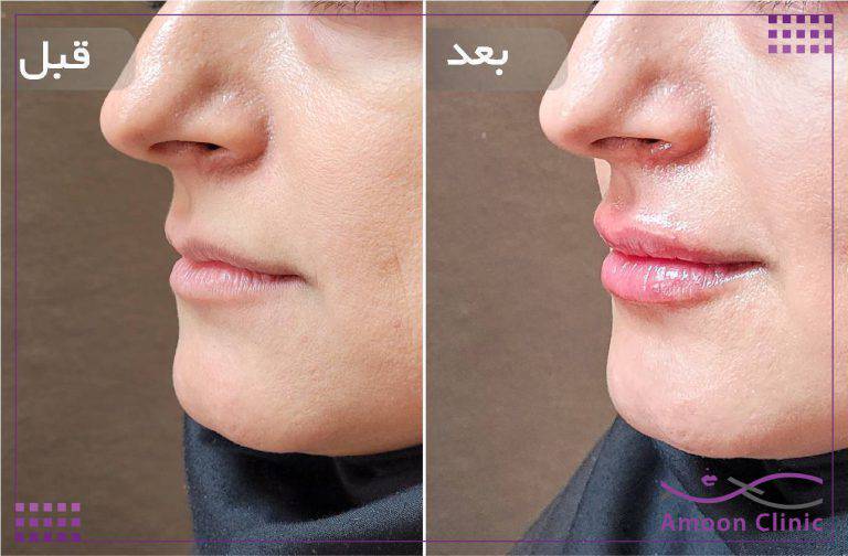 نمونه قبل و بعد زیبایی 13 قبل و بعد تزریق ژل لب از نمای سهرخ با حجمدهی طبیعی