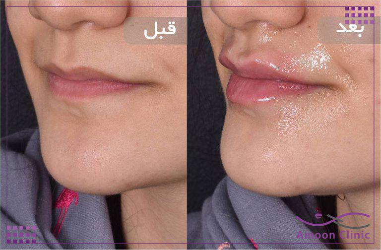 نمونه قبل و بعد زیبایی 12 قبل و بعد ژل لب و اصلاح قرینگی لب