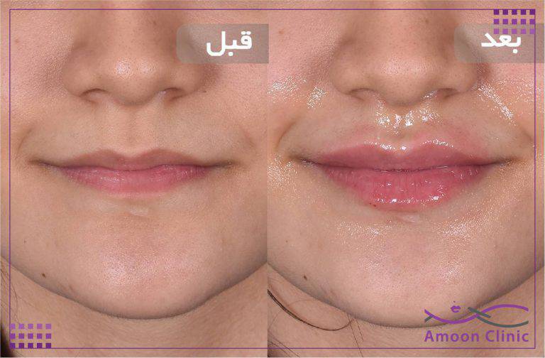 نمونه قبل و بعد زیبایی 11 قبل و بعد تزریق ژل لب از نمای نزدیک
