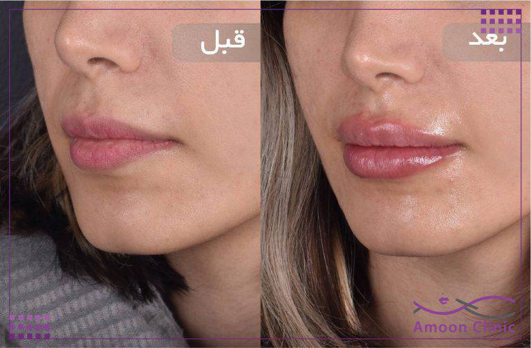 نمونه قبل و بعد زیبایی 10 قبل و بعد ژل لب با حجم ملایم و طبیعی
