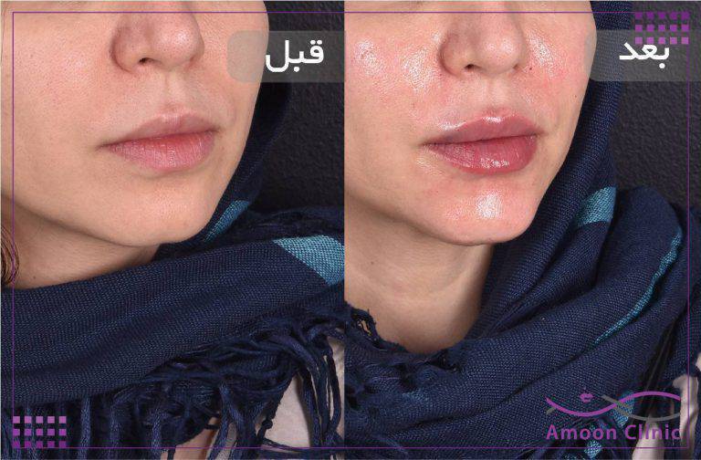 نمونه قبل و بعد زیبایی 59 قبل و بعد تزریق ژل زیر چشم و رفع گودی