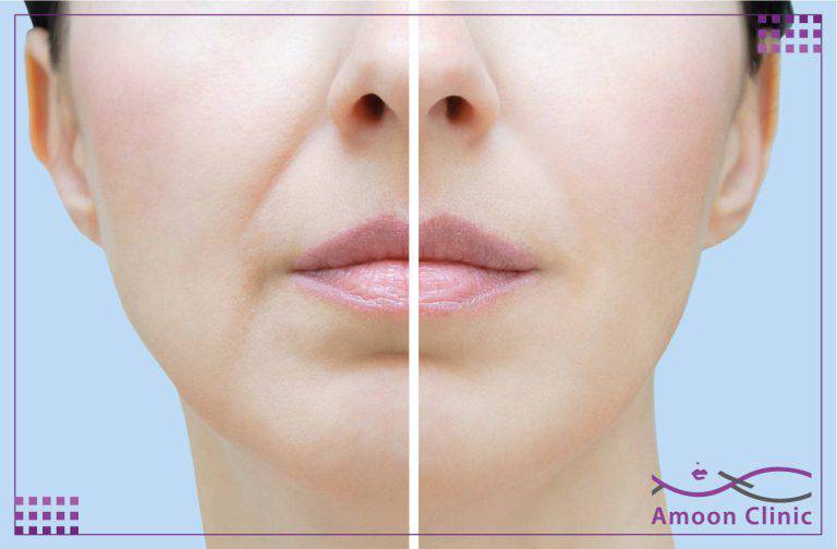 تزریق ژل خط خنده 2 عوارض تزریق ژل خط خنده