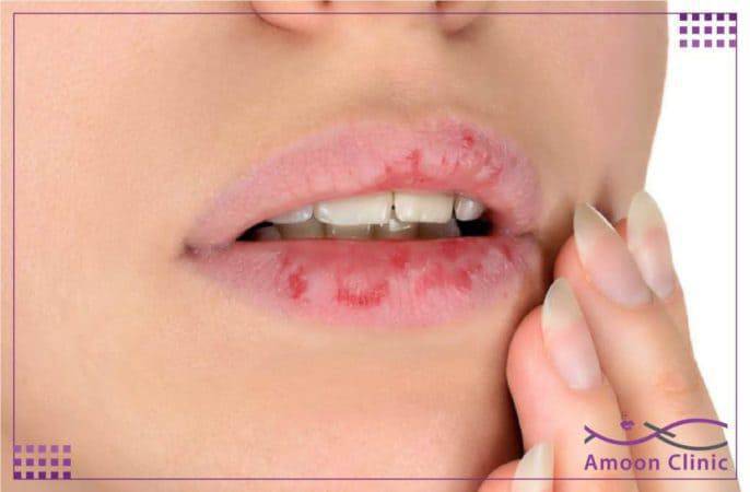 عوارض تزریق ژل لب