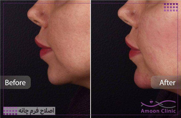 نمونه قبل و بعد زیبایی 42 قبل و بعد ژل چانه؛ نمای کناری صورت