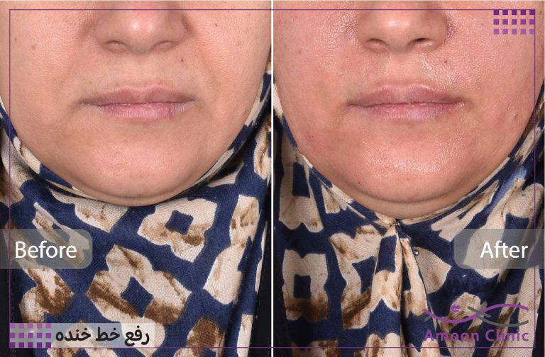 نمونه قبل و بعد زیبایی 29 قبل و بعد ژل خط خنده و کاهش افتادگی گوشه لب