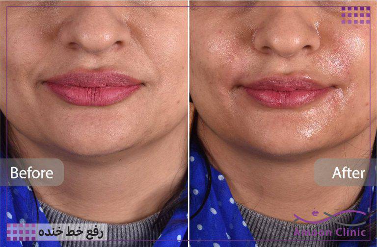 نمونه قبل و بعد زیبایی 30 قبل و بعد تزریق ژل خط خنده در کلینیک آمون