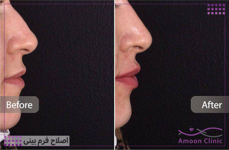 نمونه قبل و بعد زیبایی 51 قبل و بعد اصلاح قوز بینی با ژل؛ نمای نیمرخ